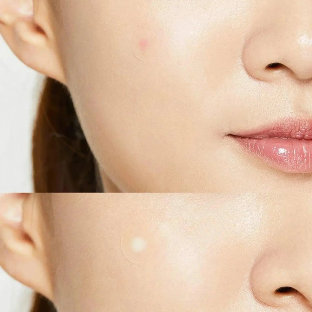 COSRX Acne Pimple Master Patch (24 Patches)